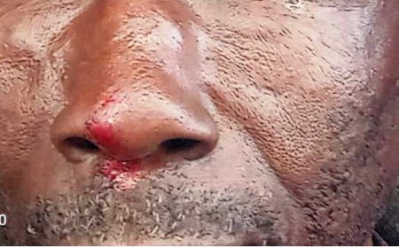 Visually Impaired Man Attacker Pleads Guilty to  Assault