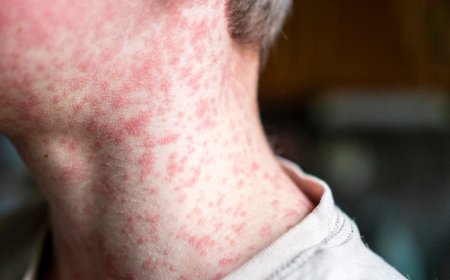 Measles Outbreak Hits USA as South Carolina Cases Rise to 985
