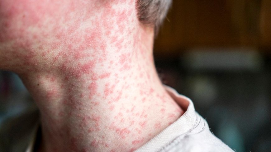 Measles Outbreak Hits USA as South Carolina Cases Rise to 985